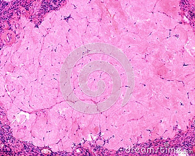 Human ovary. Corpus albicans Stock Photo