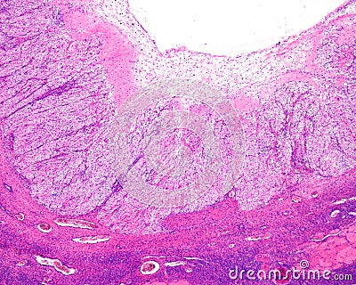 Human ovary. Regression of corpus luteum Stock Photo