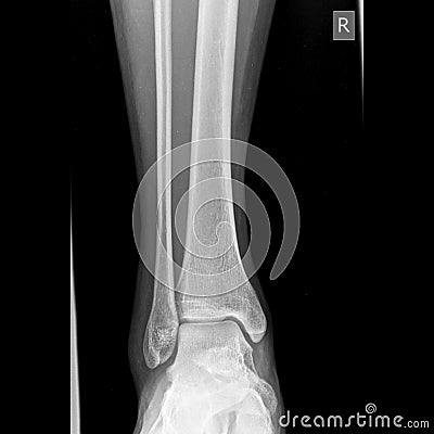 Ankle joint x-ray image AP view Stock Photo