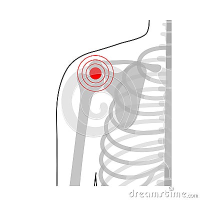 Human shoulder joint pain anatomy. Vector Illustration