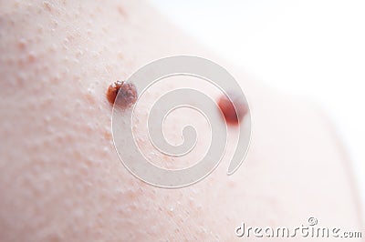 Human skin and moles Stock Photo