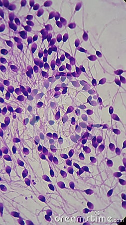 Human spermatozoon, frotis semen sample Stock Photo