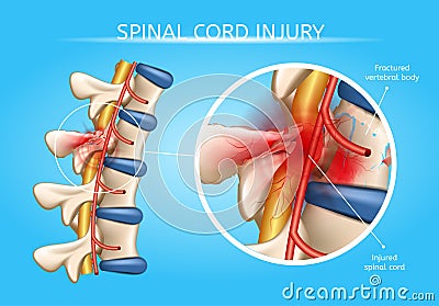 Human Spinal Cord Injury Anatomical Vector Scheme Vector Illustration