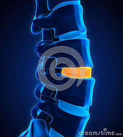 Human Spine Disc Degenerative Stock Photo