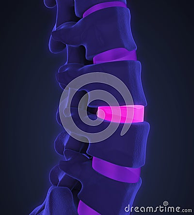 Human Spine Disc Degenerative Stock Photo