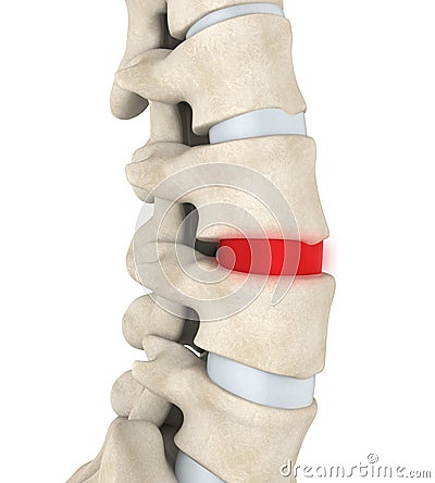 Human Spine Disc Degenerative Stock Photo