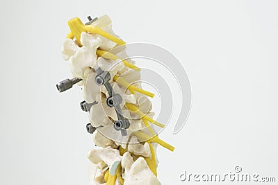 Human spine model with instrument fixation Stock Photo