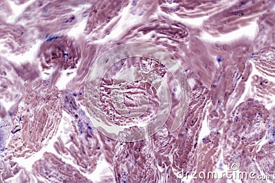 Human squamous cell carcinoma. Tissues affected by cancer cells under a microscope Stock Photo