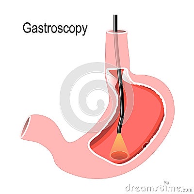Human Stomach with endoscope Vector Illustration