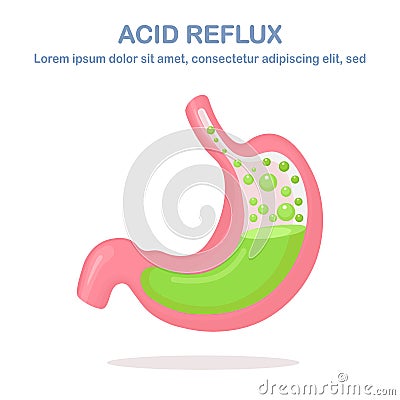 Human stomach. Gastroesophageal reflux disease. GERD, heartburn, gastric infographic. Acid moving up into the esophagus. Vector Vector Illustration