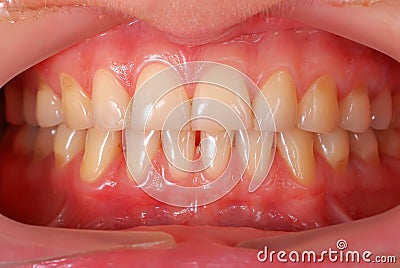 Human teeth Stock Photo