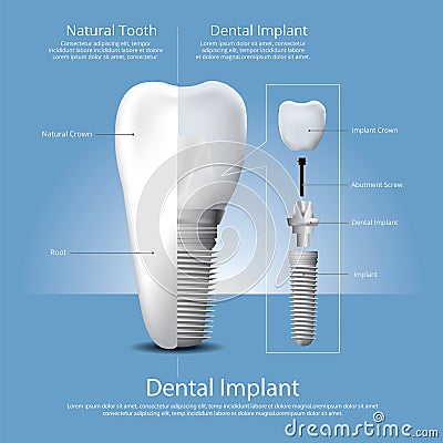 Human teeth and Dental implant Vector Illustration