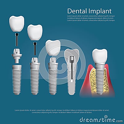 Human teeth and Dental implant Vector Illustration