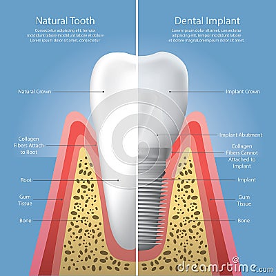 Human teeth and Dental implant Vector Illustration