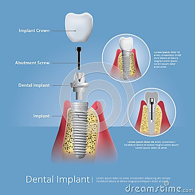 Human teeth and Dental implant Vector Illustration