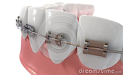 Human Teeth Extreme Closeup With Metal Braces Stock Photo