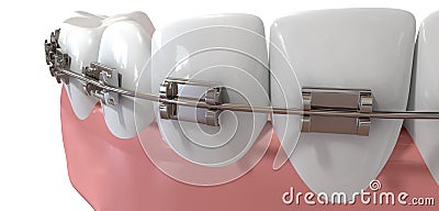 Human Teeth Extreme Closeup With Metal Braces Stock Photo