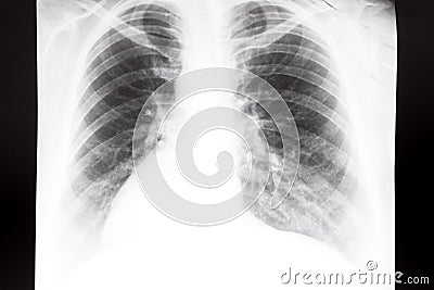 Human thorax with lungs on X-ray image Stock Photo