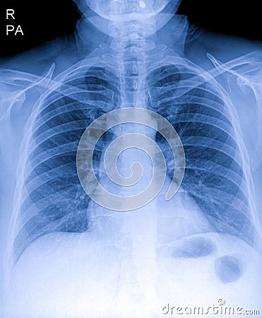 Human thorax x-ray for lungs examination, PA up right. Cancer infected lungs. Virus screening Stock Photo