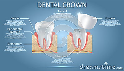 Human tooth and dental crown, vector educational poster Vector Illustration