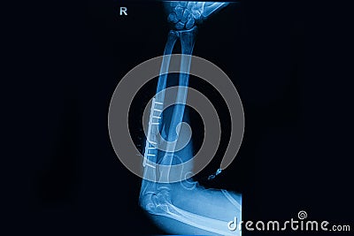 Human x-rays showing fracture of radius bone Stock Photo