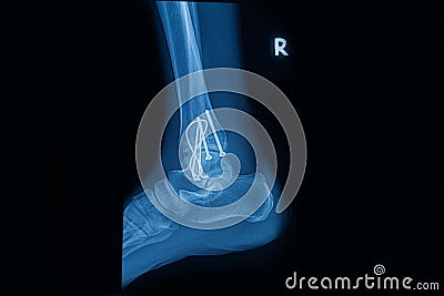 Human x-rays showing fracture of right leg Stock Photo