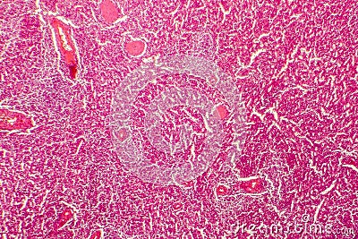 Hyaline degeneration of splenic artery Stock Photo