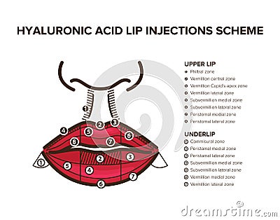 Hyaluronic acid filler. Lip injections. Lip anatomy Vector Illustration