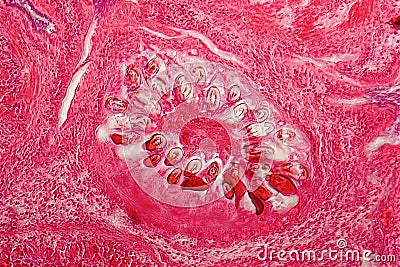 Hydatid cyst of liver caused by tapeworm parasite Echinococcus granulosus Stock Photo