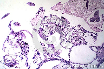 Hydatiform mole, light micrograph Stock Photo