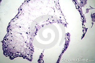 Hydatiform mole, light micrograph Stock Photo
