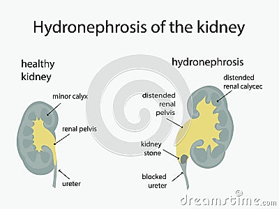 Hydronephrosis and healthy kidneys. Urology. Diagnosis of kidney disease. Vector Illustration