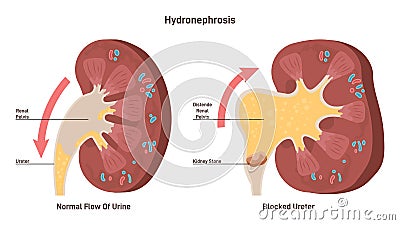 Hydronephrosis. Medical condition in which a kidney enlarge and swell Vector Illustration