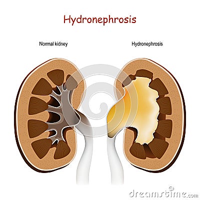 Hydronephrosis. Normal kidney and kidney with disorders Vector Illustration