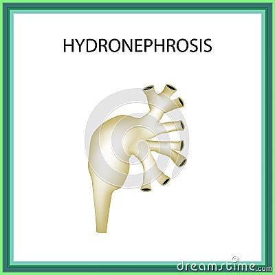 Hydronephrosis. Pelvis. Kidney. Infographics. Vector illustration on isolated background Vector Illustration