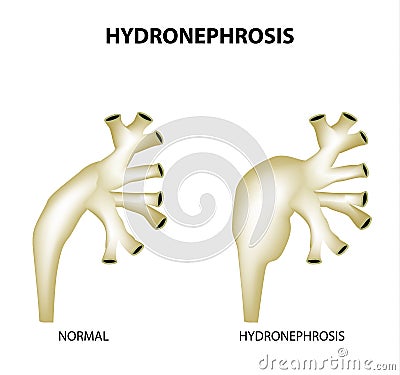 Hydronephrosis. Pelvis. Kidney. Infographics. Vector illustration on isolated background Vector Illustration