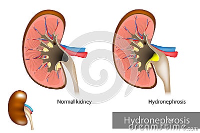 Hydronephrosis. Urinary Tract Dilation Vector Illustration