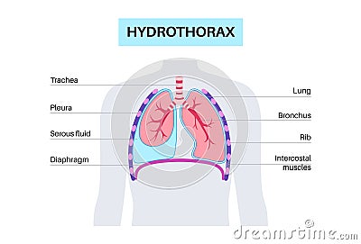 Hydrothorax medical poster Vector Illustration