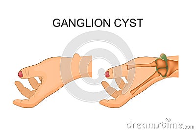 Hygroma wrist joint Vector Illustration