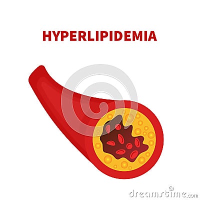 Hyperlipidemia of artery vessel blocked with a clot Vector Illustration