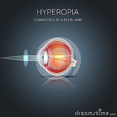 Hyperopia corrected Vector Illustration