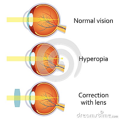 Hyperopia corrected by a plus lens Vector Illustration