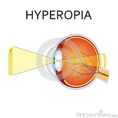 Hyperopia eyesight disorder. Vector Illustration