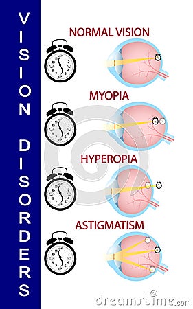 Hyperopia and Hyperopia corrected by a plus lens. Eye vision disorder Vector Illustration