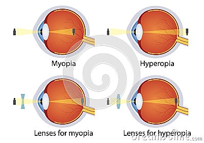 Hyperopia and myopia corrected by lens. Concept of eyes defect. Correction of various eye vision disorders by lens Vector Illustration