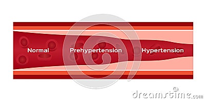 Hypertension , high blood pressure / human anatomy Vector Illustration