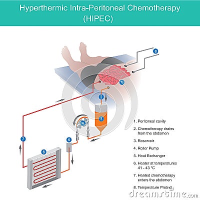 Hyperthermic Intra Peritoneal Chemotherapy. The use of chemotherapy to destroy intestine cancer cells through fluid in the abdomen Stock Photo