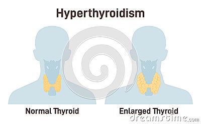 Hyperthyroidism. Thyroid gland produces too much of the hormone Vector Illustration