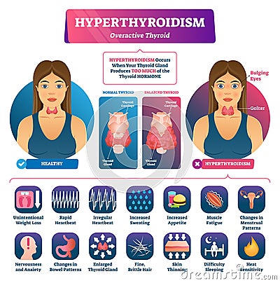 Hyperthyroidism vector illustration. Labeled medical thyroid gland disease. Vector Illustration