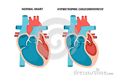 Hypertrophic cardiomyopathy with cross-section view. Human heart muscle diseases. Cardiology concept. Vector Illustration